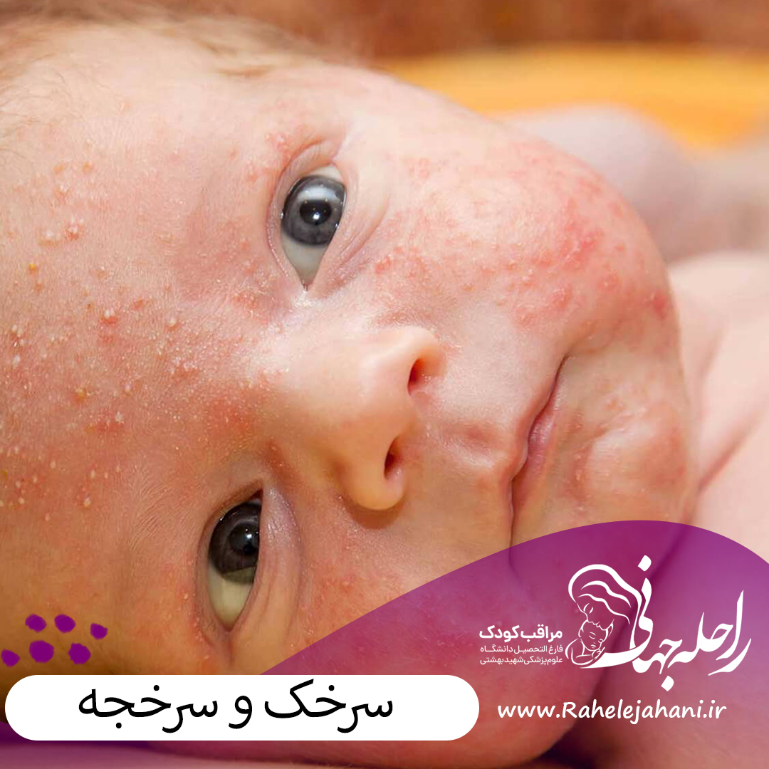 سرخک و سرخجه چیست؟